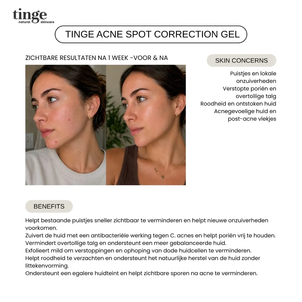 Tinge Acne spot correction gel 20 ml